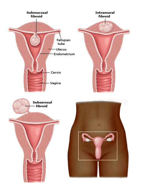 Diagram of fibroids